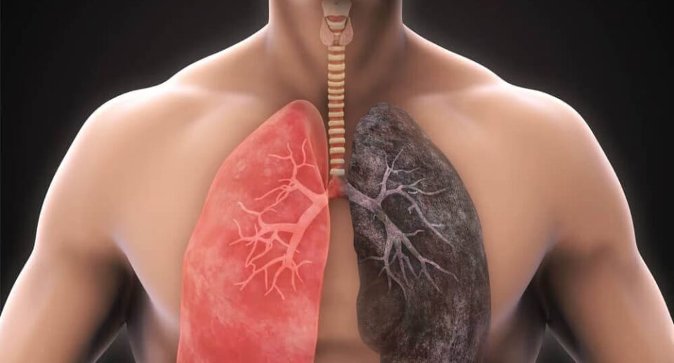 Chronic Obstructive Pulmonary Disease (COPD) Management