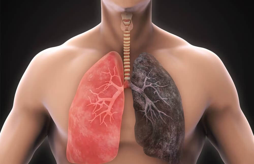 Chronic Obstructive Pulmonary Disease (COPD) Management